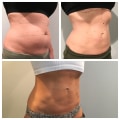 Does coolsculpting actually work?