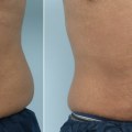 Does skin sag after coolsculpting?