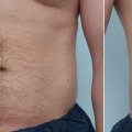 How long does it take for skin to tighten after coolsculpting?