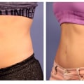 How much fat can coolsculpting remove?