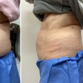 Photos and Videos of Successful Treatments: A Comprehensive Look at Cool Sculpting and Other Non-Surgical Fat Reduction Options