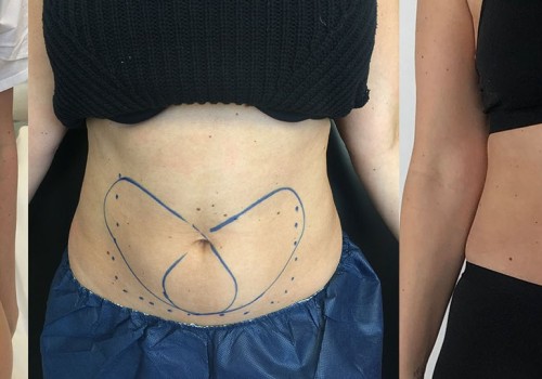 Does coolsculpting really work permanently?