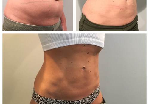 Does coolsculpting actually work?