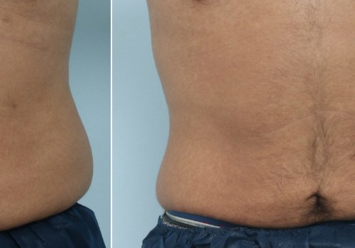 Does skin sag after coolsculpting?