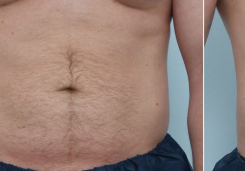 How long does it take for skin to tighten after coolsculpting?