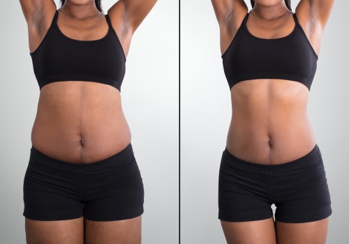 Liposuction: Understanding Cool Sculpting and Other Non-Surgical Options