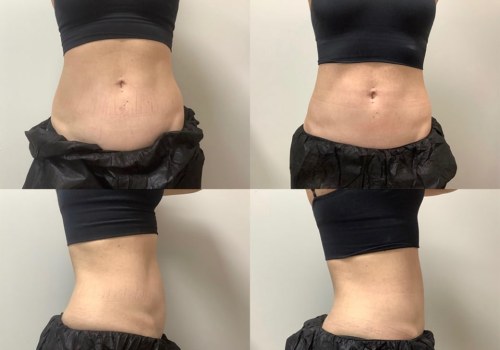 Can you see coolsculpting results in 2 weeks?