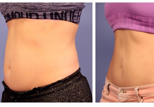 How much fat can coolsculpting remove?