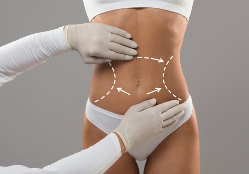 Cool Sculpting with Tummy Tuck: Achieving Your Dream Body Without Surgery