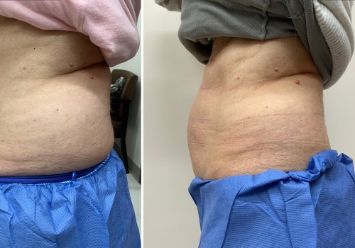 Photos and Videos of Successful Treatments: A Comprehensive Look at Cool Sculpting and Other Non-Surgical Fat Reduction Options